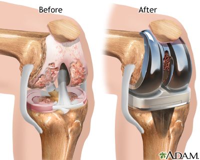 Aftercare Knee Replacement Surgery Recovery, Knee Replacement Exercises, Knee Replacement Recovery, Knee Surgery Recovery, Whole Body Vibration, Knee Problem, Knee Replacement Surgery, Orthopedic Surgery, Knee Exercises