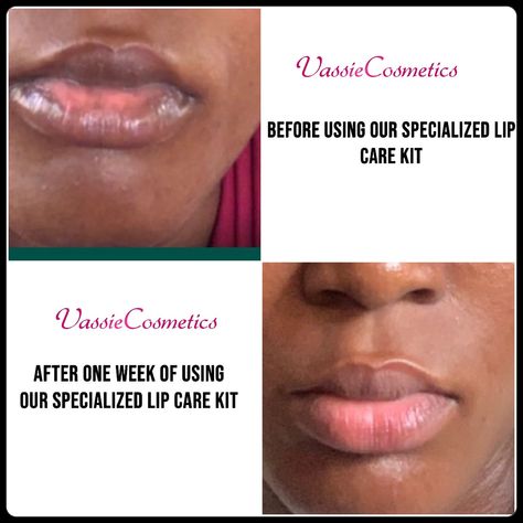 Our SPECIALIZED LIP CARE KITS are carefully designed to help get rid of Dark , Dry and Chapped Lips 👄 SWIPE TO SEE SOME OF OUR CLIENTS REVIEWS & TRANSFORMATION➡️➡️➡️ How To Use: 👄FLUFFY LIP SCRUB: The first step to achieving a healthy lips is regular exfoliation. Helps to remove dried skin cells on the lips making it soft,smooth and supple. Helps with easier penetration of the other lip care products. Use 2-3x weekly 👄LIP THERAPY BALM: Our Lip Therapy Balm helps treat dry/chapped lips an... Lips Balm, Natural Pink Lips, Pink Lip Balm, Lip Care Products, Lip Care Tips, Lip Masks, Facial Scars, Dry Flaky Skin, Lip Therapy