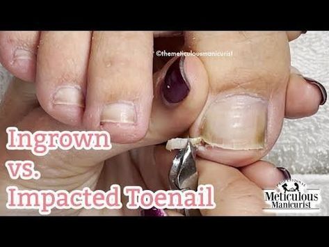 fungal nail pedicure Curled Toenails, Ingrown Toenail Remedies, Split Toenail, Fungal Infection Remedies, Infected Toenail, Toenail Removal, Toenail Health, Toenail Fungal Infection, Nail Remedies