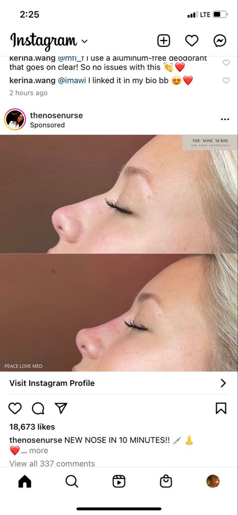 Tinkerbell Tip Lift Nose, Wide Bridge Nose Rhinoplasty, Nose Filler Before After, Nose Tip Lift, Bulbous Nose Rhinoplasty Before After, Nose Job Before And After, Natural Nose Job, Nose Job Recovery, Ideal Nose