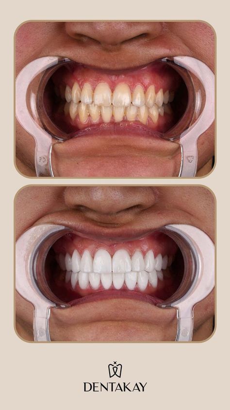 Dental Makeover, Dental Wallpaper, Dental Posters, Dental Videos, Dental Photography, General Dentistry, Hospital Design, Good Day Quotes, Perfect Smile