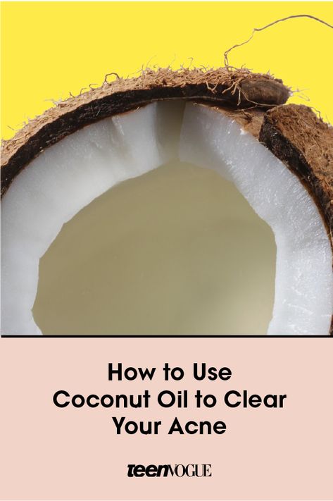 Clearing acne with coconut oil might not make a ton of sense logically, but it's actually a pretty effective tool. Here's how to use it to clear up zits. Clearing Acne, Clear Your Skin, Coconut Oil For Acne, Best Acne Products, Coconut Oil For Face, Face Care Routine, Home Remedies For Acne, Acne Solutions, Cystic Acne