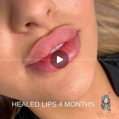 DENVER•RUSSIAN LIPS•FACIAL BALANCING•PDO THREADS on Instagram: "💫 LIP FILLER HEALED RESULTS IN A RUSSIAN LIP TECHNIQUE 4 MONTHS LATER  🔥My signature shape lips-advanced injecting technique🔥  💉Flat profile  💉Accentuated Cupid’s bow 💉Minimal pain 💉Natural shape once healed in 2 weeks   ⏰ Results last 6-12 months  ☎️ 720-319-7871( text) 🗒DM with questions  👆🏻Booking link is in Bio" Russian Lip Filler Technique, Facial Balancing, Russian Lips, Pdo Threads, Lip Filler, Medical Aesthetic, Lip Fillers, 4 Months, Natural Shapes