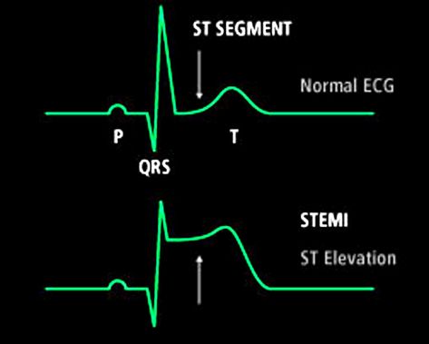 Get the real facts about STEMI heart attacks (ST Elevation Myocardial Infarction) directly from one of the world's top cardiologist. Stemi Ekg, Patient Care Tech, St Elevation, Patient Care Technician, Ekg Interpretation, Paramedic School, Nurse Manager, Nursing Mnemonics, Cardiac Nursing