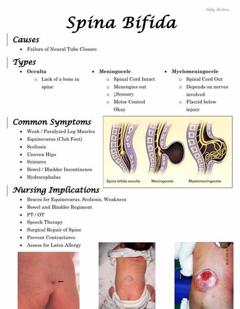 Spinal Bifida, Pediatric Nursing Study, Medical Terminology Study, Nursing Study Tips, Medical Assistant Student, Nursing School Essential, Medical School Life, Medicine Studies, Basic Anatomy And Physiology