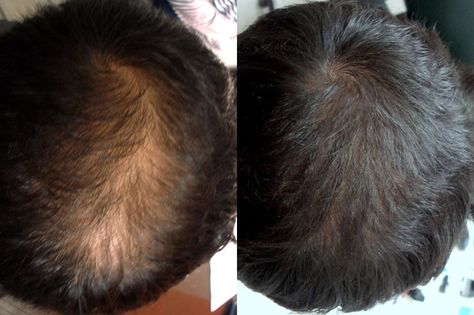 Before After Hair Growth, Hair Prp Before And After, Prp Hair Therapy Before And After, Mesotherapy Hair, Hair Groth, Prp Hair, Hair Growth For Men, Scalp Micropigmentation, Hair Transplant Surgery