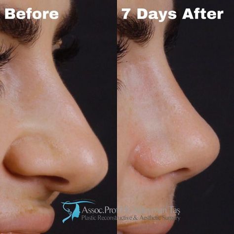 Thick Skin Bulbous Tip Rhinoplasty | Assoc. Prof. Dr. Suleyman TAS Bulbous Tip Rhinoplasty, Tip Rhinoplasty, Nose Surgery Rhinoplasty, Bulbous Nose, Rhinoplasty Nose Jobs, Job Inspiration, Pretty Nose, Perfect Nose, Small Nose