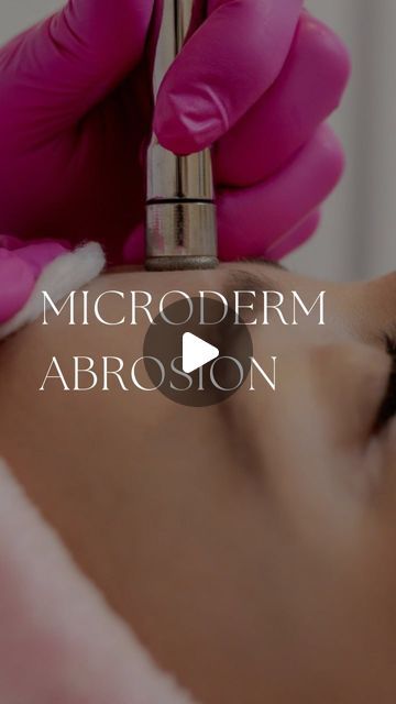 𝘿𝙞𝙖𝙢𝙤𝙣𝙙 𝙒𝙚𝙡𝙡𝙣𝙚𝙨𝙨 𝙄𝙣𝙨𝙩𝙞𝙩𝙪𝙩𝙚 on Instagram: "#microdermabrasion Facial 💆‍♀️
Microdermabrasion is a minimally invasive procedure used to renew overall skin tone and texture. It can help improve the appearance of skin affected by:
* Age spots
* Sun damage
* Darkened skin patches
* Stretch marks
* Fine lines and wrinkles
* Enlarged pores
* Acne and blackheads
* Acne scars
* Uneven skin tones or texture
* Darkened skin patches and melasma (a skin condition that causes patches and spots, usually on the face)
#microdermabrasion #facial #filler #skincare #botox #vancouver #skincareroutine #mothersdaygift" At Home Microdermabrasion, Dermatologica Daily Microfoliant, Diamond Microdermabrasion, Microdermabrasion Benefits, Home Microdermabrasion, Microdermabrasion Facial, Wedding Skincare, Skin Patches, Enlarged Pores