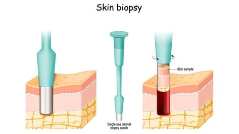 Skin Test Accurately Detects Neurodegenerative Disorders Deep Brain Stimulation, Pathology Lab, Lewy Body, Nerve Fiber, Harvard Medical School, Medical News, Internal Medicine, Aids Hiv, Clinical Trials