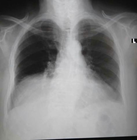 Right basal opacity with convex upper border. It is not sillhoeutting the right cardiac border nor the diaphragm. For Lateral view Brain Surgeon, Diagnostic Imaging, Icd 10, Chest Pain, Radiology, X Ray, Free Photos, Health, Instagram