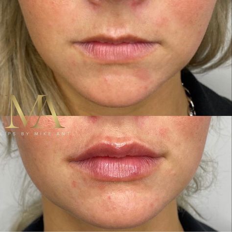 Lip Injections On Small Lips, Lip Filler For Small Lips, Small Lip Injections, Lip Fillers Before And After 1ml Small Lips, Lip Fillers Before And After 1ml Russian, Lip Filler On Small Lips, 1 Ml Lip Filler Before And After, Lip Fillers Before And After 1ml, 0.5 Ml Lip Filler Before And After