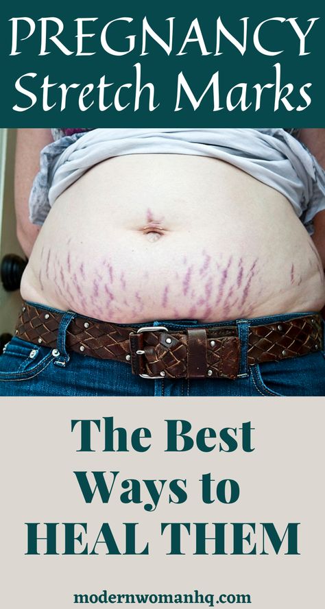 If you're looking for ways to prevent or treat stretch marks, it's crucial to first understand that they are a type of scarring that can result from sudden changes in the skin's elasticity and structure, such as during puberty or weight fluctuations. #pregnancystretchmarks,#stretchmarksandpregnancy,#stretchmarksafterpregnancy Beauty Marks, Pregnancy Body, Stretch Mark Removal, Stretch Mark Cream, Acne Remedies, Layers Of Skin, After Pregnancy, Diy Skin Care, Skin Tightening