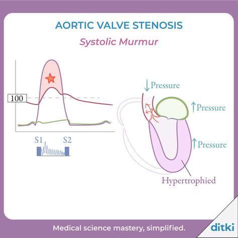 What are some causes of heart murmurs? Drop your answers, below! 👇️ Learn more: https://ditki.com/course/pathology/glossary/pathophysiologic-disorder/heart-murmurs-stenosis-regurgitation #ditki #usmle #meded #medschool #medstudent #pathology #cardiovascularpath #usmletutorials #heartmumur #nursing #pance #physicianassistant #osteopath #allopath #medicine #science #healthscience #nurse #premed #mcat #mbbs Aortic Valve Stenosis, Heart Murmurs, Transverse Myelitis, Clinical Pathology, Airway Management, Nclex Prep, Medical Student Study, Pre Med, Quiz Questions