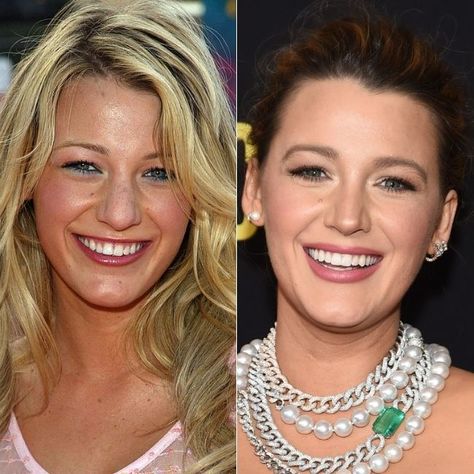 Celebrity Veneers, Celebrities With Veneers, Hollywood Smile, Gap Teeth, Porcelain Veneers, Teeth Straightening, Perfect Teeth, Dental Veneers, Celebrities Before And After