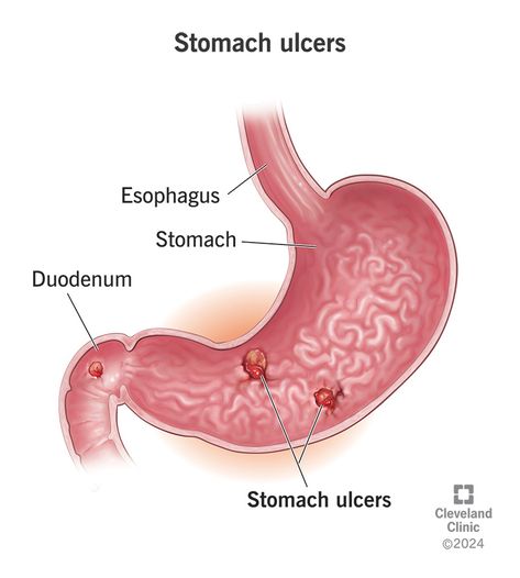 How Do You Get a Stomach Ulcer? Ulcer Symptoms, Brain Health Supplements, Digestive Juice, Organic Supplements, Stomach Ulcers, Reflux Disease, Lung Disease, Stomach Acid, Stomach Pain