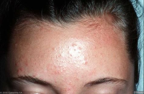 Treat Fungal Acne, Acne Types, Fungal Acne, Face Types, Forehead Acne, Constant Headaches, Greasy Skin, Acne Mask, Types Of Acne