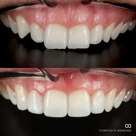 Composite Edge Bonding Teeth, Composite Bonding Teeth Before And After, Edge Bonding Teeth, Composite Bonding Teeth, Teeth Bonding, Space Between Teeth, Composite Bonding, Dental Studio, Dental Bonding