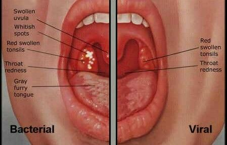 Bacterial vs Viral Sore Throat Swollen Uvula, Throat Ulcers, Swollen Tonsils, Throat Remedies, Sore Throat Remedies, Low Sodium Recipes Blood Pressure, Throat Pain, Blood Pressure Symptoms, Throat Infection