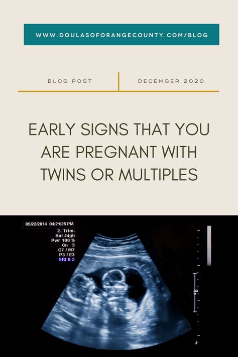 There are some early signs that you could be expecting more than one bundle of joy! Scroll through to see if you might be pregnant with multiples and for tips on soothing your symptoms. #twinmom #tripletmom #pregnancy #pregnantwithtwins #rainbowbaby #orangecountydoula #doulaorangecounty #findadoula #birthdoula #postpartumdoula Hcg Levels By Week Pregnancy, Signs Of Twin Pregnancy, Twins Ultrasound, Triplets Pregnancy, Pregnancy Morning Sickness, Pregnant Life, Hcg Levels, Morning Sickness Remedies, Pregnant With Twins