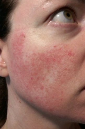 Cheek 1 - May 28 - Rosacea images subtype 1 and subtype 2 redness and bumps. #rosacea #rosaceaimages #rosaceapicture Stretch Mark Prevention Pregnancy, Stretch Mark Cream Pregnancy, Clearing Acne, Face Inspiration, Marks Cream, Imagenes Mary Kay, Dark Spots On Face, Skincare Routines, How To Get Rid Of Pimples