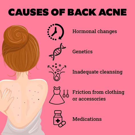 #acne #acnetreatment #acnetips #backacne #acnetips Back Acne Causes, Best Self Quotes, Back Acne, Acne Vulgaris, Type Treatments, Acne Causes, Acne Facial, Hormonal Acne, Face Acne