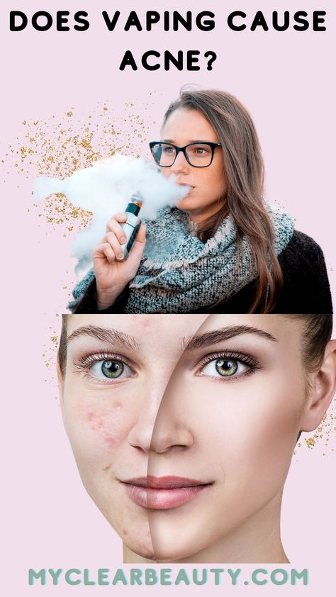 Vaping has been linked to a variety of health concerns, including acne. The chemicals found in e-cigarettes, such as propylene glycol and glycerin, can contribute to skin inflammation and breakouts. To maintain clear skin, it may be best to avoid vaping altogether. Propylene Glycol, Clear Skin, Chemicals, Acne, Skin Care, Skin, Health