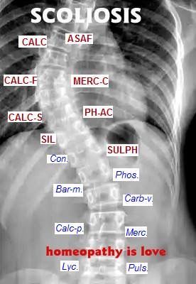 Homeopathy for Scoliosis Homoeopathy Clinical Tips, Bone Healing Foods, Exercises For Lower Back, Cell Salts, Acne Medicine, Herbal Medicine Recipes, Homeopathy Remedies, Flower Remedies, Bach Flower Remedies