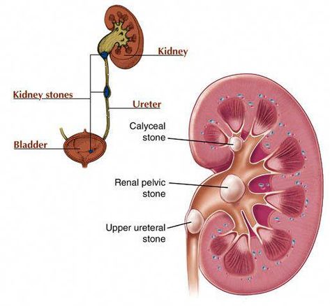 Renal Calculi, Uric Acid Crystals, Kidney Pain, Creatinine Levels, Kidney Detox, Kidney Stone, Uric Acid, Kidney Health, Health Life