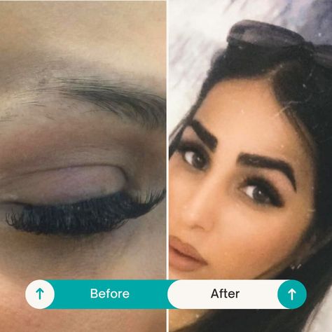 Eyebrow Transplant Surgery: What to Expect and How to Prepare Eyebrow Implants, Hair Transplant Women, Eyebrow Transplant, Alopecia Hairstyles, Hair Transplant Procedure, Fue Hair Transplant, Best Hair Transplant, Edges Hair, Aesthetic Medicine