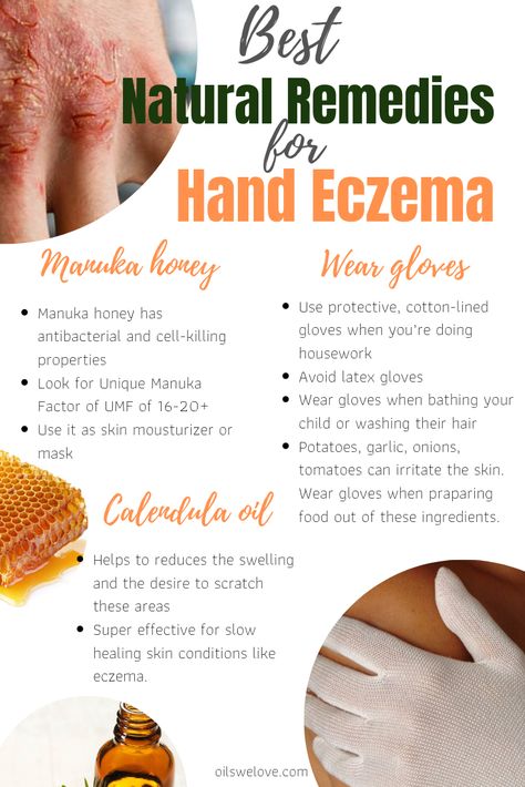 Atopic Skin Diet, Natural Remedies For Excema, Excema Remedies, Aip Lifestyle, Dry Hand Skin, Natural Asthma Remedies, Asthma Remedies, Body Aches, Skin Care Routine For 20s