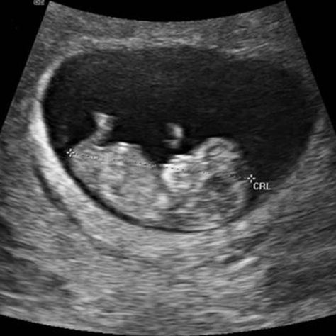 First Trimester Ultrasound Pictures 8 Weeks Pregnant Ultrasound Pictures, Baby Boy Ultrasound Pictures, 12 Week Ultrasound Pictures, 10 Week Ultrasound Pictures, 8 Weeks Pregnant Ultrasound, 10 Weeks Pregnant Ultrasound, Ultrasound Pictures 8 Weeks, Boy Ultrasound Pictures, 10 Week Ultrasound