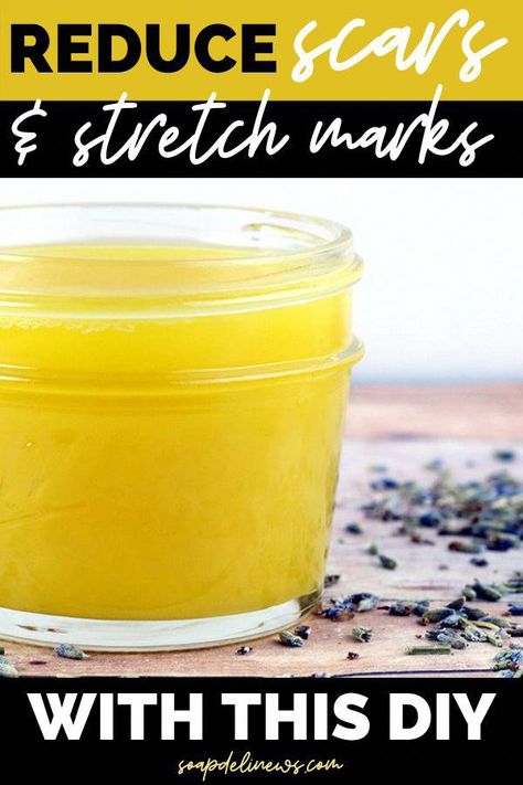 #NaturalSleepRemedies Homemade Salve Recipes, Get Rid Of Scars, Getting Rid Of Scars, Stretch Mark Remedies, Salve Recipes, Losing 40 Pounds, Skin Natural Remedies, Cold Sores Remedies, Natural Sleep Remedies