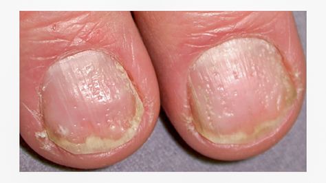 hard and rough nail surface with pitting Dents In Nails, Pitted Nails, Nail Disorders, Toenail Fungal Infection, Nail Discoloration, Nail Problems, Nail Infection, Nail Vitamins, Vitamin Deficiency