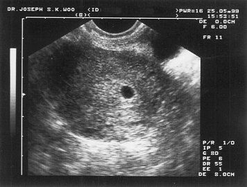 Blip's first picture :) Usg Kehamilan, 4 Weeks Pregnant Ultrasound, 4 Weeks Pregnant, Henna Recipe, Pregnancy Test Results, Fake Pregnancy, Mommy And Baby Pictures, Baby Ultrasound, Ultrasound Pictures