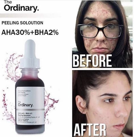 The Ordinary aha 30% bha 2% peeling solution before and after Aha Peeling Solution, Ordinary Peeling Solution, The Ordinary Peeling Solution, Acne Prone Skin Care, Peeling Solution, Best Acne Products, Deep Exfoliation, Skincare Inspiration, Sugar Scrub Diy