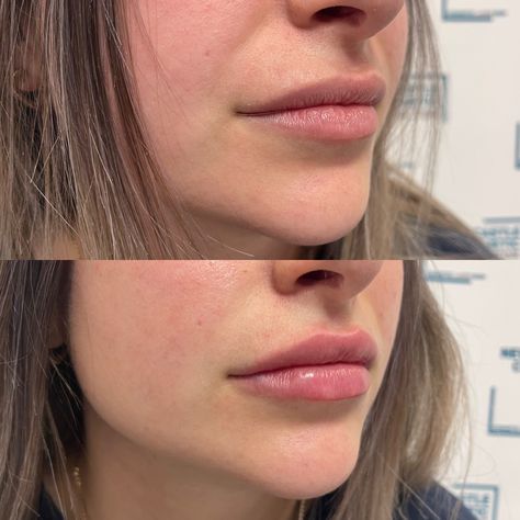 0 5 Ml Lip Filler, 0.5 Ml Lip Filler Before And After, Face Plastic Surgery, Botox Face, Lip Filler, Stage Makeup, Skin Clinic, Beautiful Body, Lip Fillers