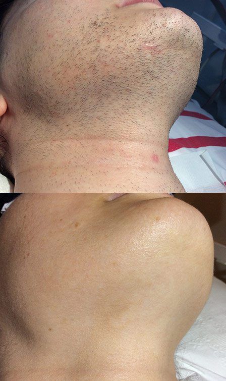 Are you looking for a permanent hair removal method? Permanence is here to help. We offer our permanent, safe, and effective hair removal for men using our unique galvanic multi-probe electrolysis method. What's more, we will permanently remove your unwanted hair from all body and facial areas. Call now! Laser Hair Removal Men, Laser Hair Removal Face, Permanent Facial Hair Removal, Electrolysis Hair Removal, Underarm Hair Removal, Permanent Hair Removal, Hair Removal For Men, At Home Hair Removal, Hair Removal Methods