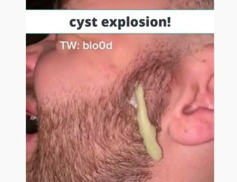 Zit Popping Video Faces, Big Zits, Popping Pimples Videos Youtube, Lip Pimple, Nose Pimples, Huge Pimple, Ear Pimple, Back Pimples, Painful Pimple