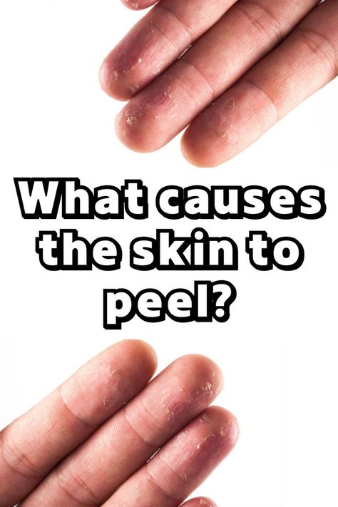 n this blog post, we will explore the various causes of finger peeling, as well as potential treatments and prevention methods. Skin Peeling On Hands, Peeling Fingertips, Natural Antifungal, Daily Hygiene, Vitamin Deficiency, Skin Hand, Clear Nail, Health Heal, Hygiene Routine