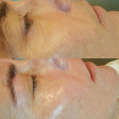 Before and after of Dermaplaning Before and after of Dermaplane Dermaplaning Before And After, Derma Planing, Laser Hair Removal Face, Waxing Studio, Skin Care Hacks, Permanent Facial Hair Removal, Ingrown Hair Remedies, Nose Hair Removal, Waxing Tips