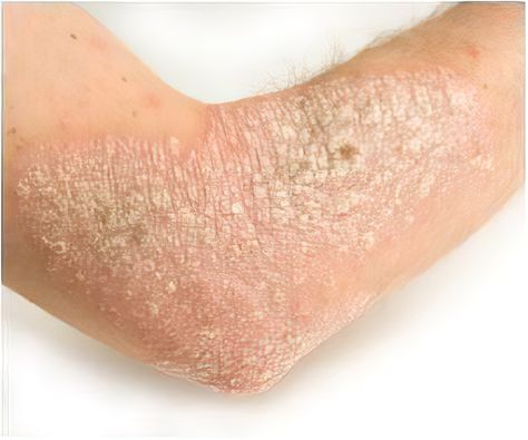 Scientists have discovered a possible culprit behind eczema and allergic skin diseases. Fungal Rash, Bow Legged Correction, Dry Skin Remedies, Skin Condition, Skin Diseases, Kombucha, Skin Conditions, Young Living, Natural Remedies