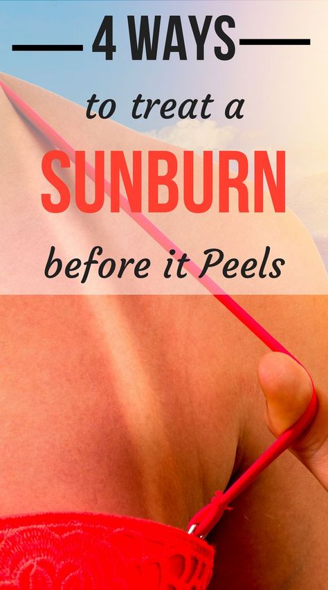 Sunburn On Face, Sunburn Blisters, Sunburn Face, How To Help Sunburn, Sunburnt Face, Get Rid Of Sunburn, How To Treat Sunburn, Sunburn Peeling, Heal Sunburn