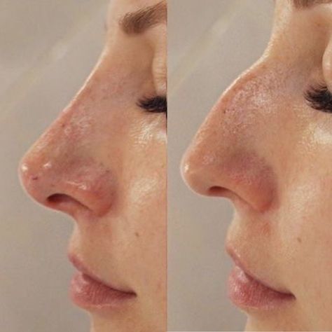 Rhinoplasty Before And After Front View, High Radix Nose, Nose Job Before And After Rhinoplasty, Nose Filler Before After Non Surgical, Droopy Nose, Bad Nose Jobs, Kylie Jenner Plastic Surgery, Nose Filler, Jaw Reduction Surgery