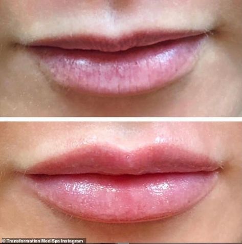 Pdo Threads Lips, Mini Lip Filler, Lip Threading Before And After, Wrinkly Lips, Lip Threading, Thread Veins, Lip Flip, Lip Lift, Lip Blushing