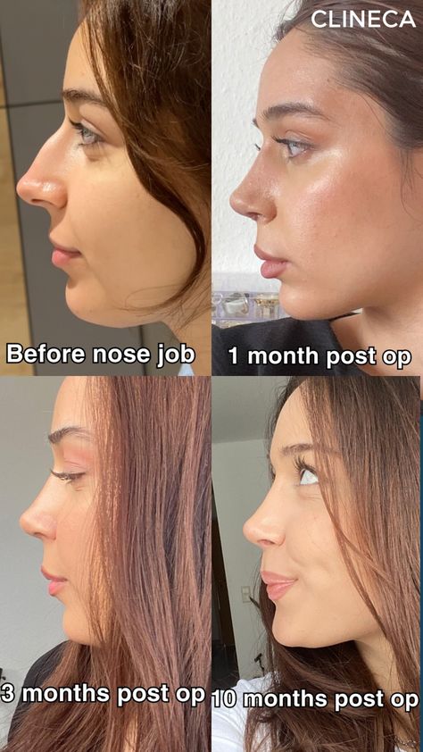 👃 1 Month: Swelling starts to go down, and the new shape is becoming more defined, but patience is key! You’ll notice changes daily.  💫 3 Months: Significant progress! Most of the swelling has subsided, and you’ll start seeing the final shape of your nose. Time to enjoy the results! 🌟  🌿 6 Months: Full healing and refinement of your nose's appearance. Your new look is here to stay! 🙌  Trust the process & enjoy your transformation! 💖 #NoseJob #Rhinoplasty #BeforeandAfter Side Profile Before And After, Rhinoplasty Results, Turkey Nose Job, Best Nose Shape, Subtle Nose Job, Nosejob Rhinoplasty Before After, Lower Blephoraplasty Before And After, Beautiful Nose Shape, Nose Job Inspiration Natural