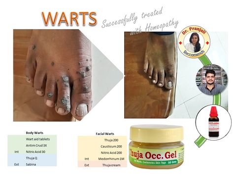 body and facial warts Oils For Warts, Natural Remedies For Warts, Different Types Of Warts, Filiform Wart, Types Of Warts, Natural Wart Remedies, Facial Warts, Wart Remover, Homeopathy Remedies