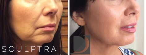 #Sculptra not only adds volume where volume may be lost, but it tightens the skin and really helps the texture of the skin. Sculptra Before And After Faces, Sculptra Before And After, Sculptra Aesthetic, Liquid Facelift, Facial Wrinkles, Medical Spa, Surgery, Wrinkles, The Face