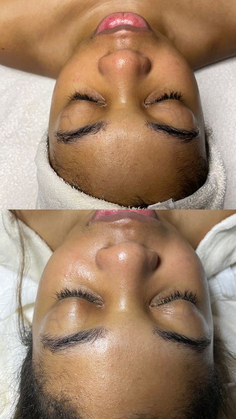 Plant Peel on this beauty 🪴 -Retexturizes skin -Improves radiance and softness of skin -Helps to even out skin tone Esthetician page: skinbybgabrielle #michiganesthetician #licensedesthetician #clearskinproducts Chemical Peel Results, Best Chemical Peel, Chemical Peel, Even Out Skin Tone, Esthetician, Clear Skin, Skin Tones, Skin, Beauty