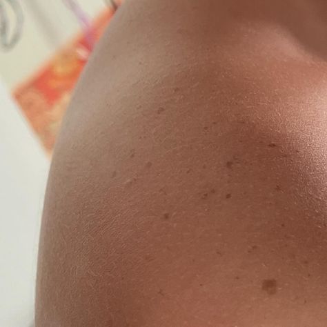 Freckles On Shoulders, Sun Kissed Freckles, Leg Freckles, Sydney Watson, Shoulder Freckles, Obx Shifting, Freckles Aesthetic, Body Freckles, Sun Freckles