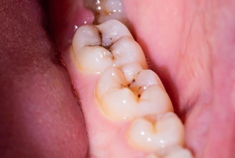 3,3′-Diindolylmethane (DIM) decreased the Streptococcus mutans biofilm, a leading contributor to plaque and cavities, by 90%. A significant portion of the global population experiences persistent issues with dental plaque and cavities or will face them at some time. While toothpaste, mouthwash, and Dental Sealants, Dental Plaque, Dental Cavities, Tooth Sensitivity, How To Prevent Cavities, Medical News, Alternative Treatments, Dental Hygiene, Tooth Decay